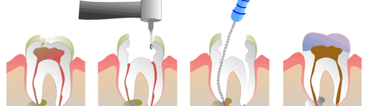 Endodontik Tedavi