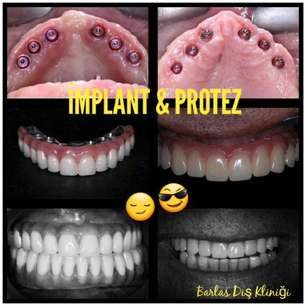 implant 2